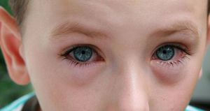 Конъюнктивит - особенности заболевания глаз