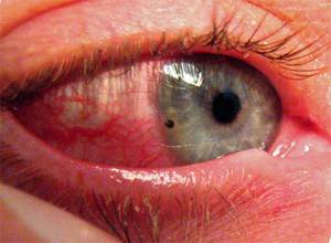 Симптомы конъюнктивита - воспаленные глаза, выделения