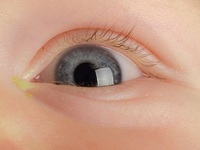 Загноившийся глаз у ребенка