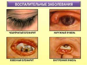 Как лечат воспаления глаз