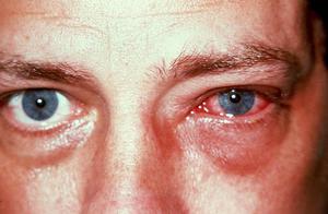 Симптомы заболевания глаз