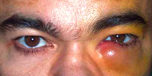 Дакрицистит слезной протоки и другие болезни глаз