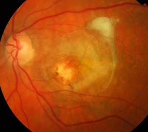 Как проявляется дистрофия сетчатки глаза