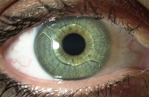 Признаки вторичной катаракты
