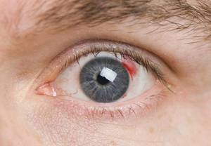 Описание диабетической ангиопатии сетчатки глаз