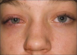 Что такое кератит глаз