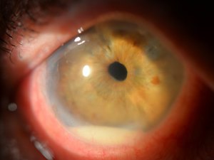 Иридоциклит - сочетанное воспаление радужки и ресничного (цилиарного) тела глаза