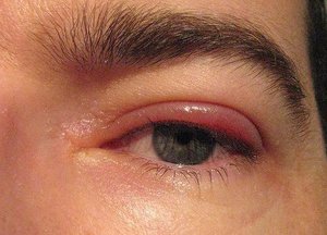 Описание воспалительных заболеваний глаза