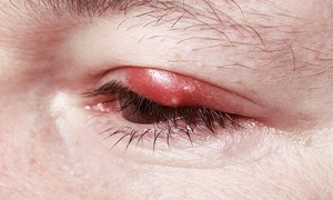 Описание симптомов воспаления глаз