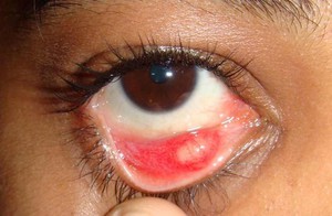 Особенности воспалительных процессов глаз