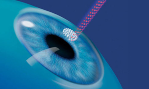 Лазер поможет исправить зрение