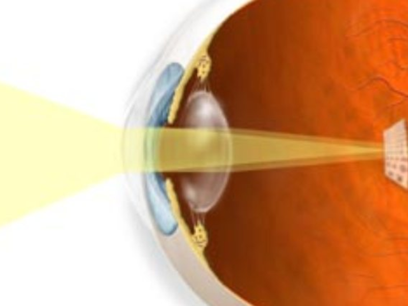Особенности глаза при астигматизме