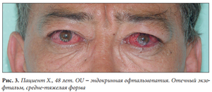 Эндокринная офтальмопатия - особенности течения болезни