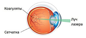 Отзывы о лазернойкоагуляции сетчатки глаза