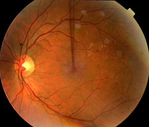 Трамва и развитие ретинопатии