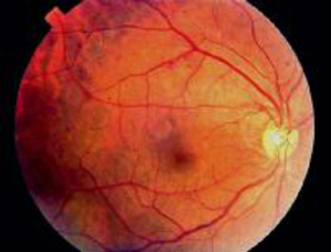 Как диагностируется ретинопатия