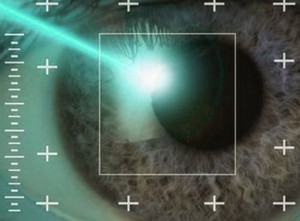 Операция глаукомы - современная коррекция лазером