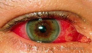 Заболевание глаз