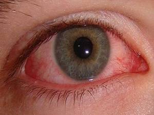 Методы леченя конъюктивита глаз