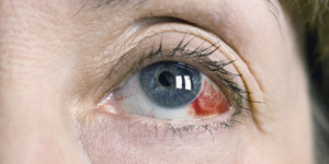 Как лечить кровоизлияние в глазах