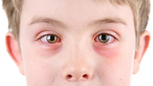 Конъюнктивит и аллергия