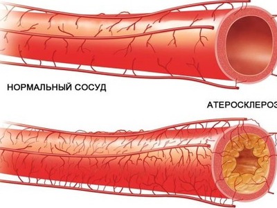 Боковая окклюзия фото