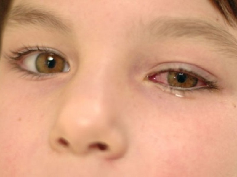 Чем лечат глаза при конъюктивите