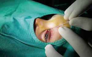 Операция на глазу при дакриоцисте - эффетивность