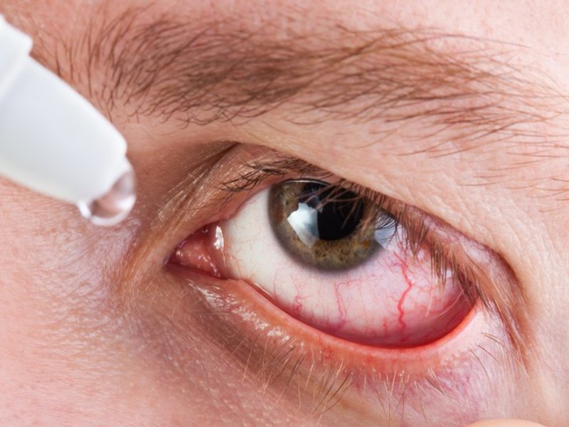 Какие капли для глаз подойдут при воспалении слезного канала