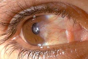 Как лечат глазные заболевания
