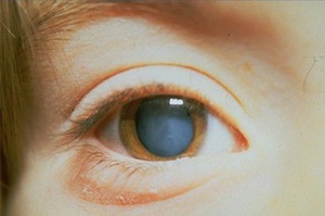 Почему развивается катаракта