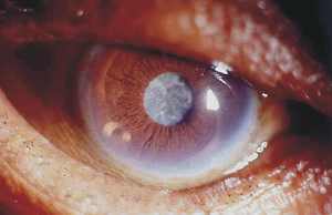 Заболевания глаз катаракта