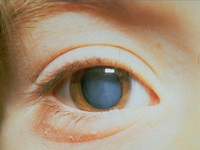 Причины развития катаракты