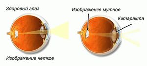 Что значит ослажненная катаракта