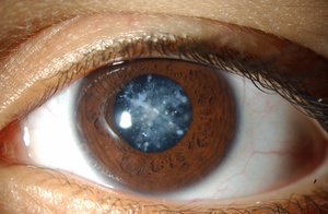 Как лечат катаракту глаза