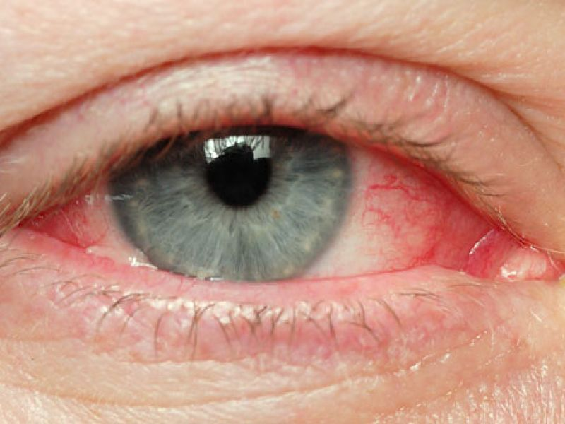 Глаз при вирусном конъюнктивите