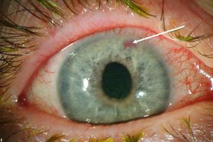 Как лечат глаукому глаза