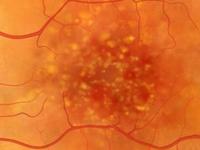 Диагностирование дистрофии сетчатки глаза