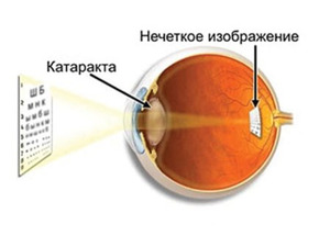 Стоимость операции на глаза
