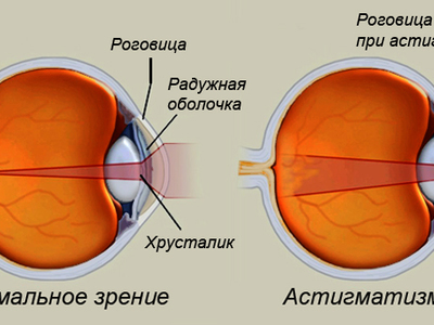 Астигматизм Лечение У Взрослых Лазером Цена