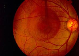 Серозная ретинопатия