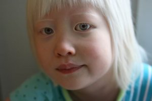 Альбинизм и нистагм