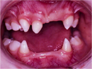 Состояние зубов при эктодермальной дисплазии