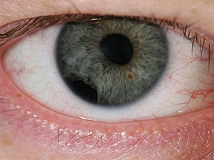 Стадии развития ангиопатии сетчатки глаз