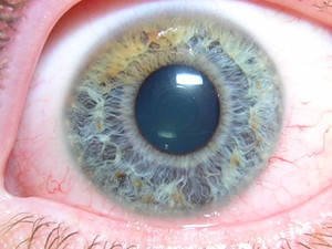 Описание гипотонической ангиопатии сетчатки глаз