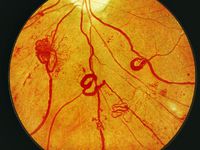 Заболевание дабетическая ретинопатия