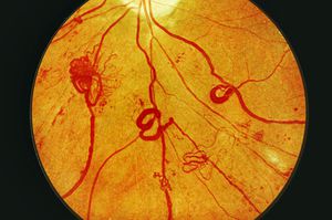 Заболевание дабетическая ретинопатия