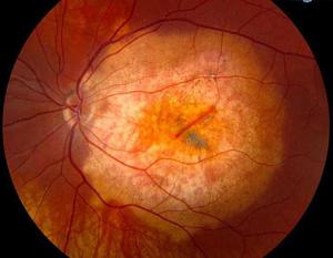 Симптомы диабетической ретинопатии