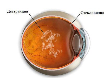 Грыжа стекловидного тела фото