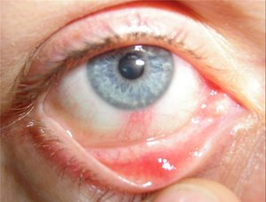 Способы лечения кератита глаз